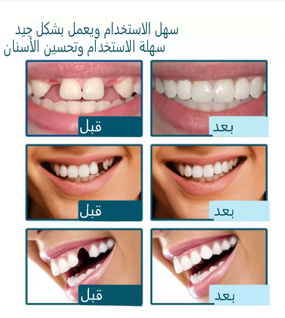 أسنان تجميلية قابلة للتركيب فوراً